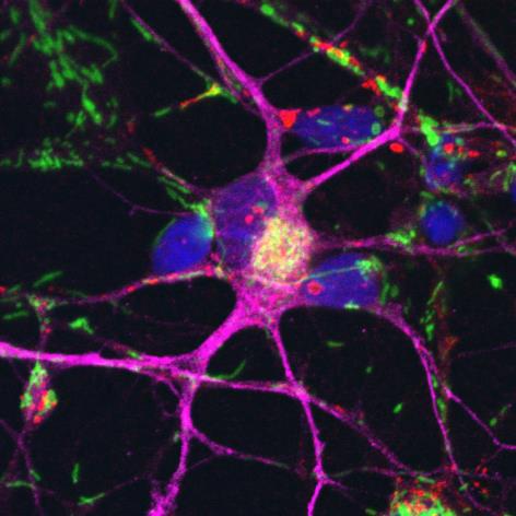 Nervenzellen (lila), die aus Stammzellen von Parkinsonpatienten entwickelt wurden. Die Zellkerne sind blau, die Mitochondrien grün gefärbt. Copyright: Deleidi, 2018