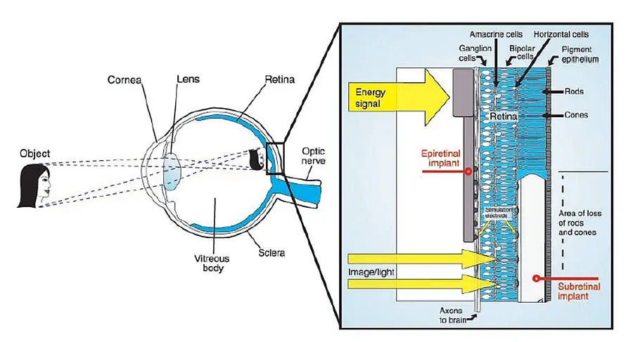 Info graph on a retina implant