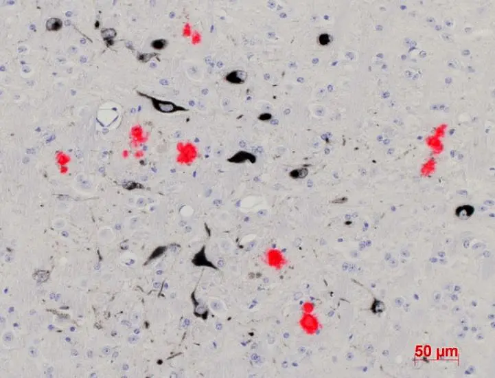 Hirngewebe einer Maus mit Alzheimer-ähnlichen Symptomen. Die Beta-Amyloid-Plaques sind rot angefärbt.