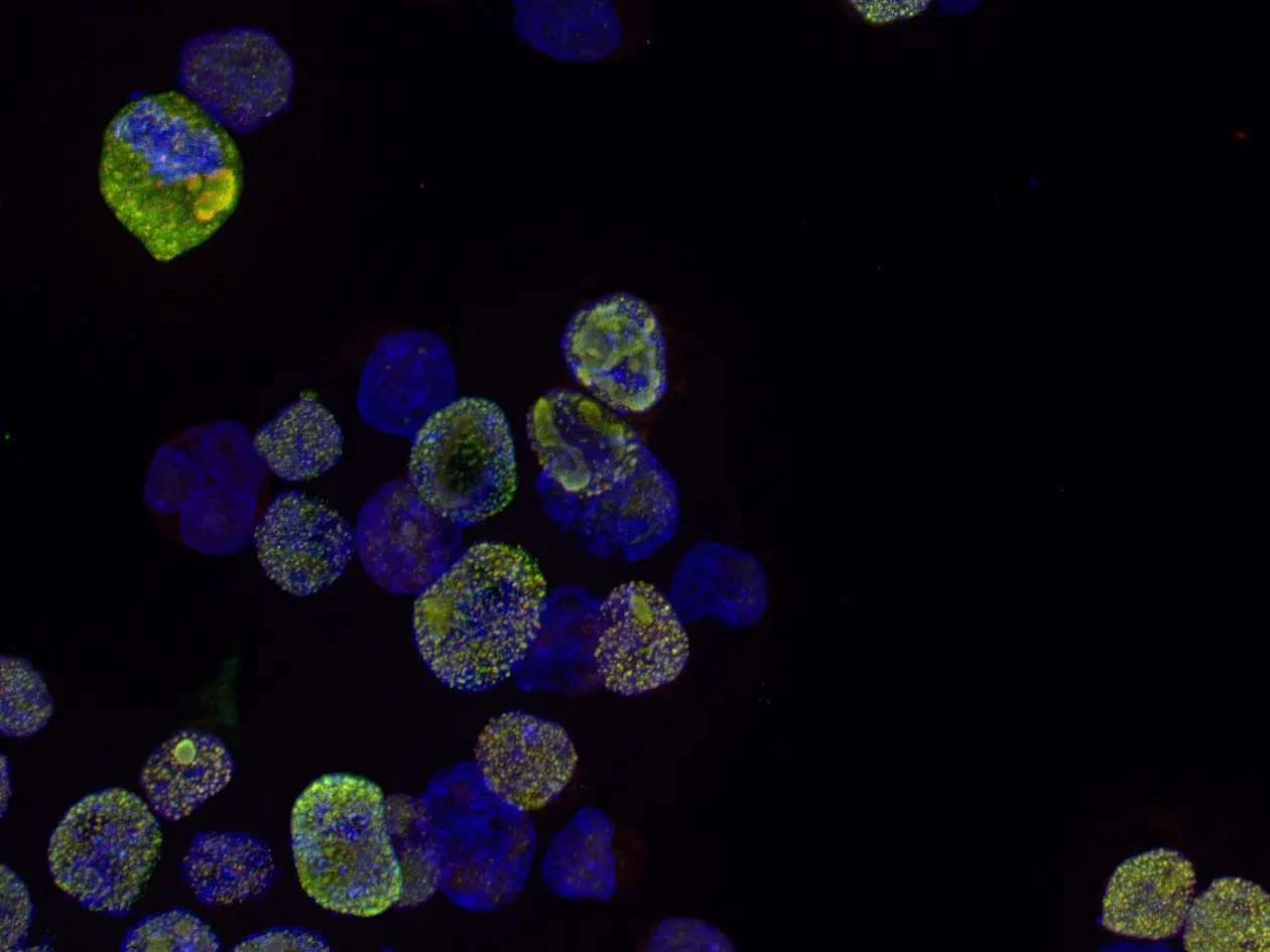 Menschliche Zellen in der Petrischale. Die acetylierten TDP-43-Proteinklümpchen sind gelb gefärbt, die DNA in den Zellkernen ist blau gefärbt.