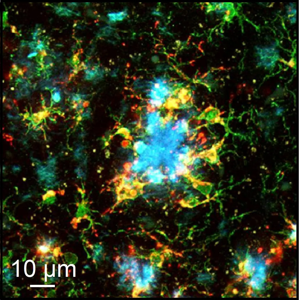 Amyloid proteins (plaques, blue) in the cerebral cortex of a mouse model of Alzheimer’s disease, surrounded by cortical immune cells (microglia, green). Activated microglia cells (positive for CD-68) are marked red. Image: O. Garaschuk/PNAS