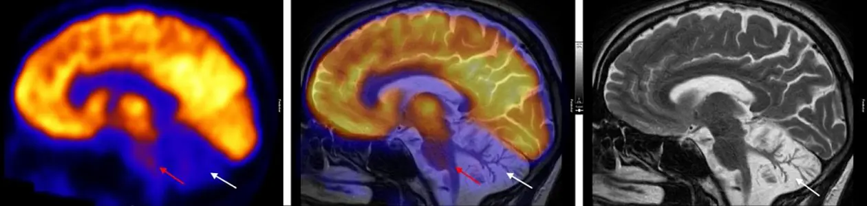 Stoffwechselaktivität des Gehirns (links: PET, Positronen-Emissions-Tomographie) und Struktur des Gehirns (rechts: MRT, Magnetresonanztomographie) sowie die Überlagerung beider Bilder (Mitte) bei einem Patienten mit SYNE1-Erkrankung. Im Kleinhirn sind bereits viele Nervenzellen abgestorben (rechte Abbildung; weißer Pfeil). Die Stoffwechselaktivität ist nicht nur im Kleinhirn stark reduziert (weiße Pfeile), sondern auch im Hirnstamm (rote Pfeile, Hirnstamm leuchtet nicht mehr gelb). Das zeigt, dass die SYNE1-Ataxie viele verschiedene Gehirnbereiche betrifft. Abbildung: © Dr. Mona Mustafa, Klinik für Nuklearmedizin, LMU München