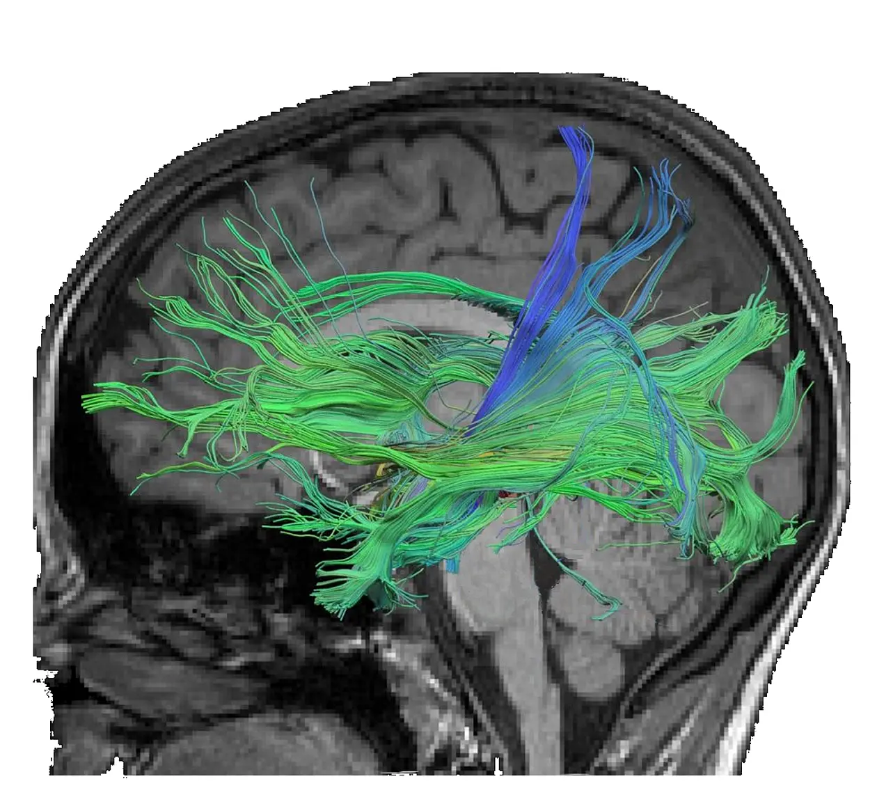 Fiber connections of the brain passing through the Hippocampus and associated with the retrieval of numeric facts. Media-based training strengthened the conductivity of the fibers connected to long-term memory. Figure: Leibniz-Institut für Wissensmedien (IWM)