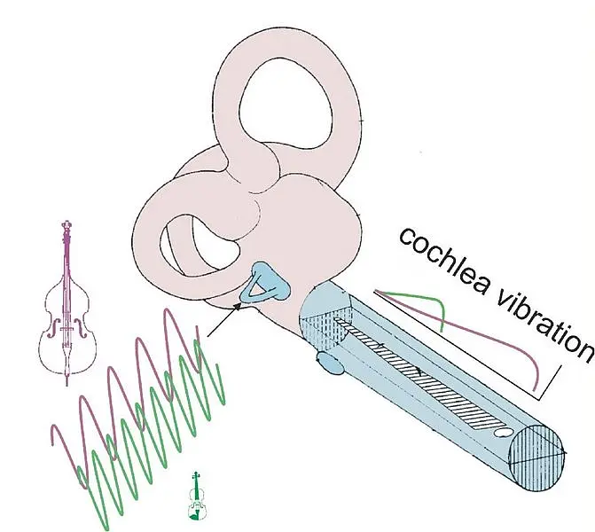 The figure shows how a Cochlea Implant works
