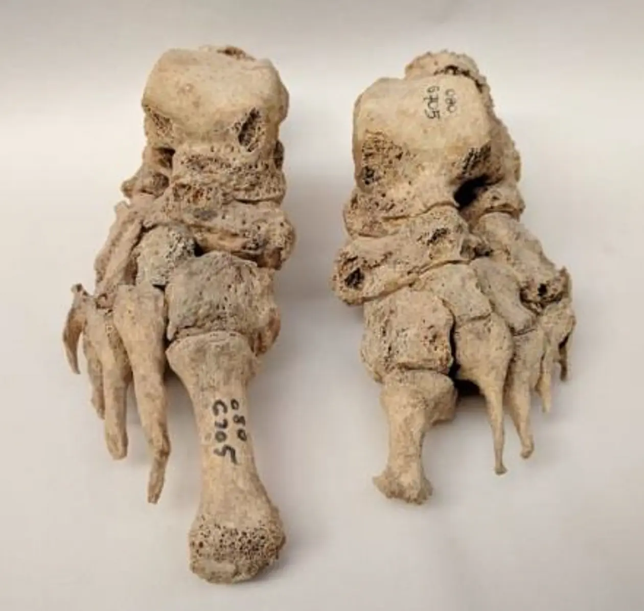 Skeletal remains showing evidence of leprosy from the Odense St. Jørgen cemetery in Denmark, which was established in 1270 and existed until 1560. Photo credit: Dorthe Dangvard Pedersen