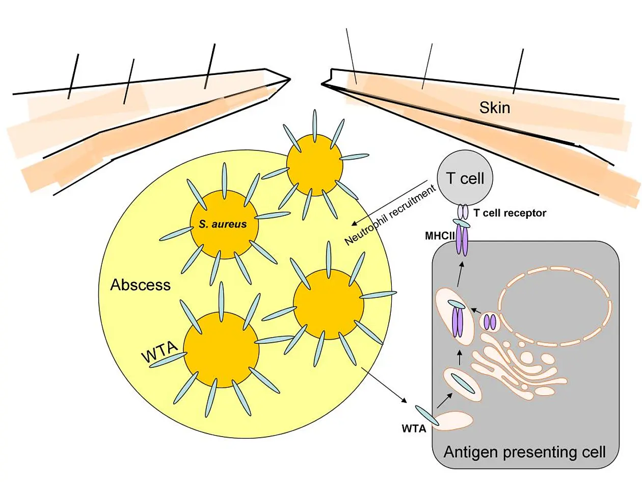 Das Zellhüllen-Zuckerpolymer Wandteichonsäure (WTA) von Staphylococcus aureus spielt bei der Entwicklung von Hautinfektionen eine Rolle. Besonders bei Infektionen mit hoch aggressiven sogenannten „Community-Associated Methicillin-Resistant Staphylococcus aureus“ (CA-MRSA), die einen im Gegensatz zu weniger aggressiven S. aureus Stämmen erhöhten WTA-Gehalt aufweisen, führt dies zu einer verstärkten Immunreaktion. Diese Immunreaktion beschleunigt die Ausbildung eines Abszesses der normalerweise die Infektion einschränken sollte, im Falle der CA-MRSA allerdings zu einem schwereren Infektionsverlauf beiträgt. Abbildung: Universität Tübingen.