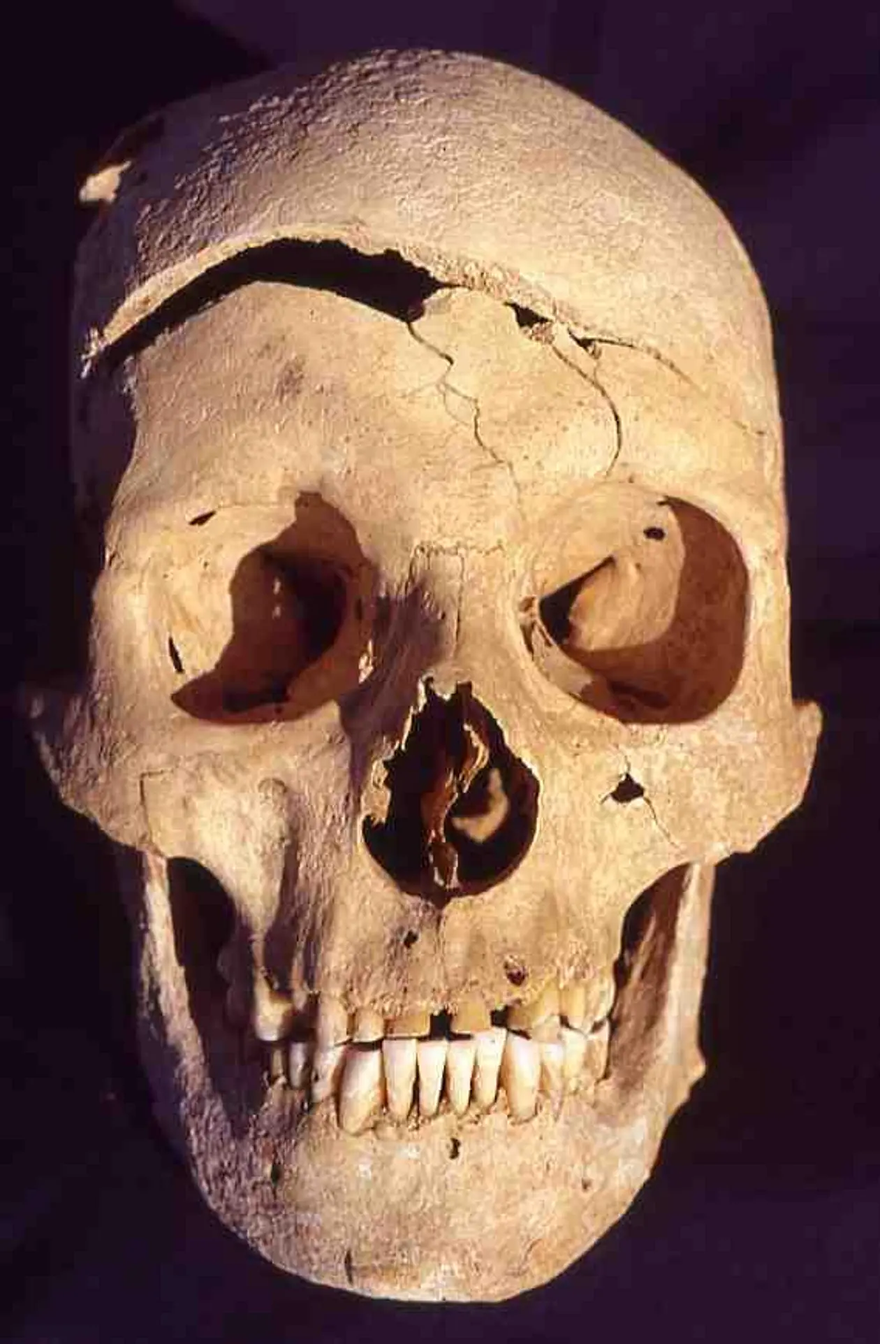 Researchers collected data from 15,000 human remains. Damage to this skull from Schwetzingen near Heidelberg indicates a violent death
