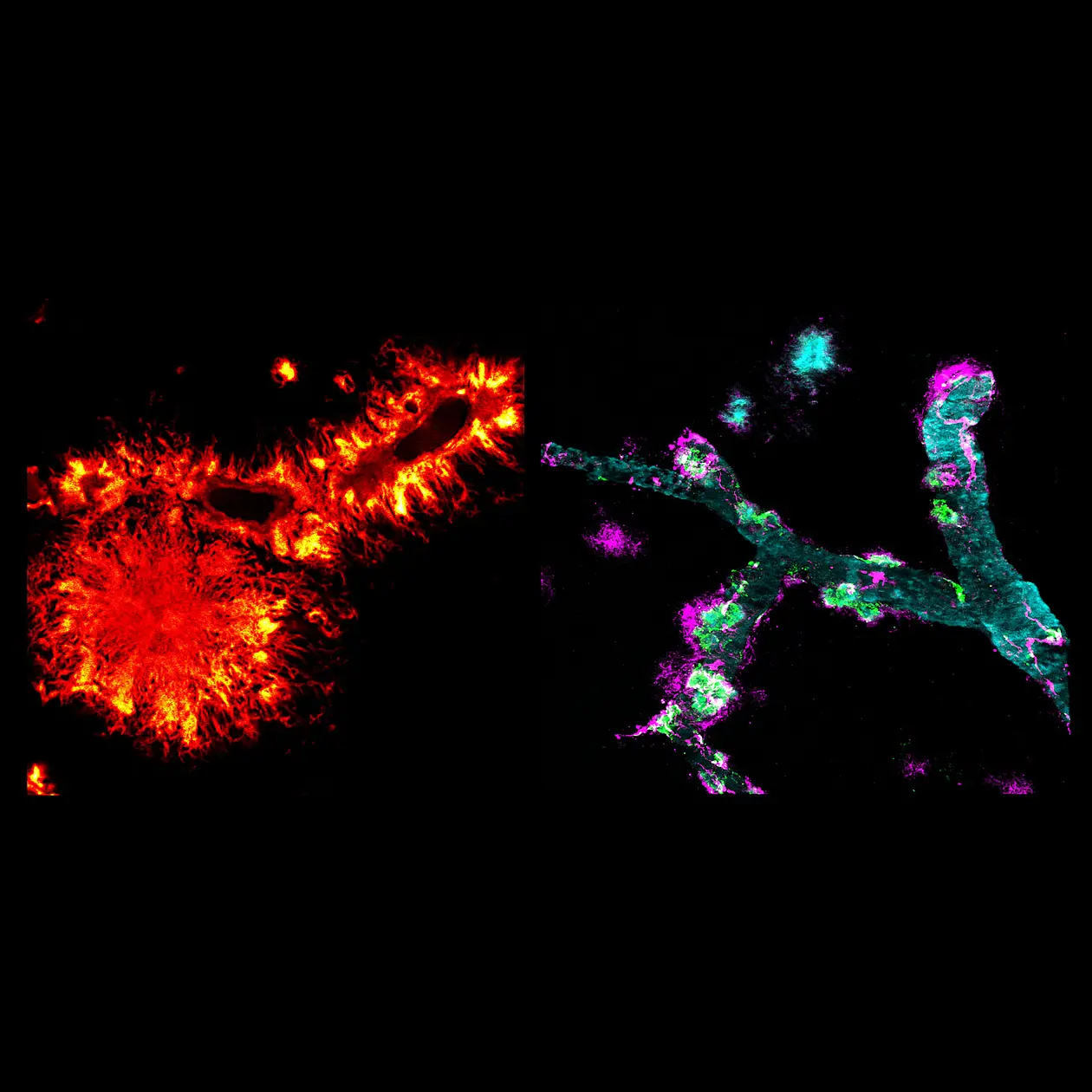 The red-yellow image shows an amyloid plaque resembling a flower in the lower left. Above and to the upper right are cross-sections of blood vessels with flame-like amyloid fibrils. In the second image, a blood vessel can be seen in bluish color containing amyloid beta and medin deposits - color-coded in purple and green. 