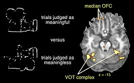 Activation within the orbitofrontal cortex (OFC) and the ventral occipito-temporal (VOT) complex 