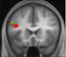 Functional magnetic resonance imaging