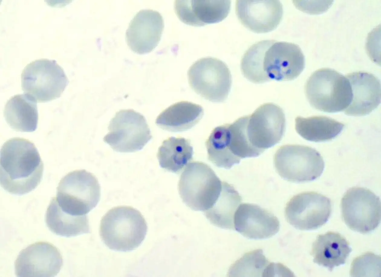 Mikroskopische Aufnahmen des Malaria-Parasiten Plasmodium falciparum. Der Parasit - als dunkelblauer Ring, Punkt oder Halbkreis zu sehen – hat menschliche Blutzellen befallen. Foto: Universität Tübingen 